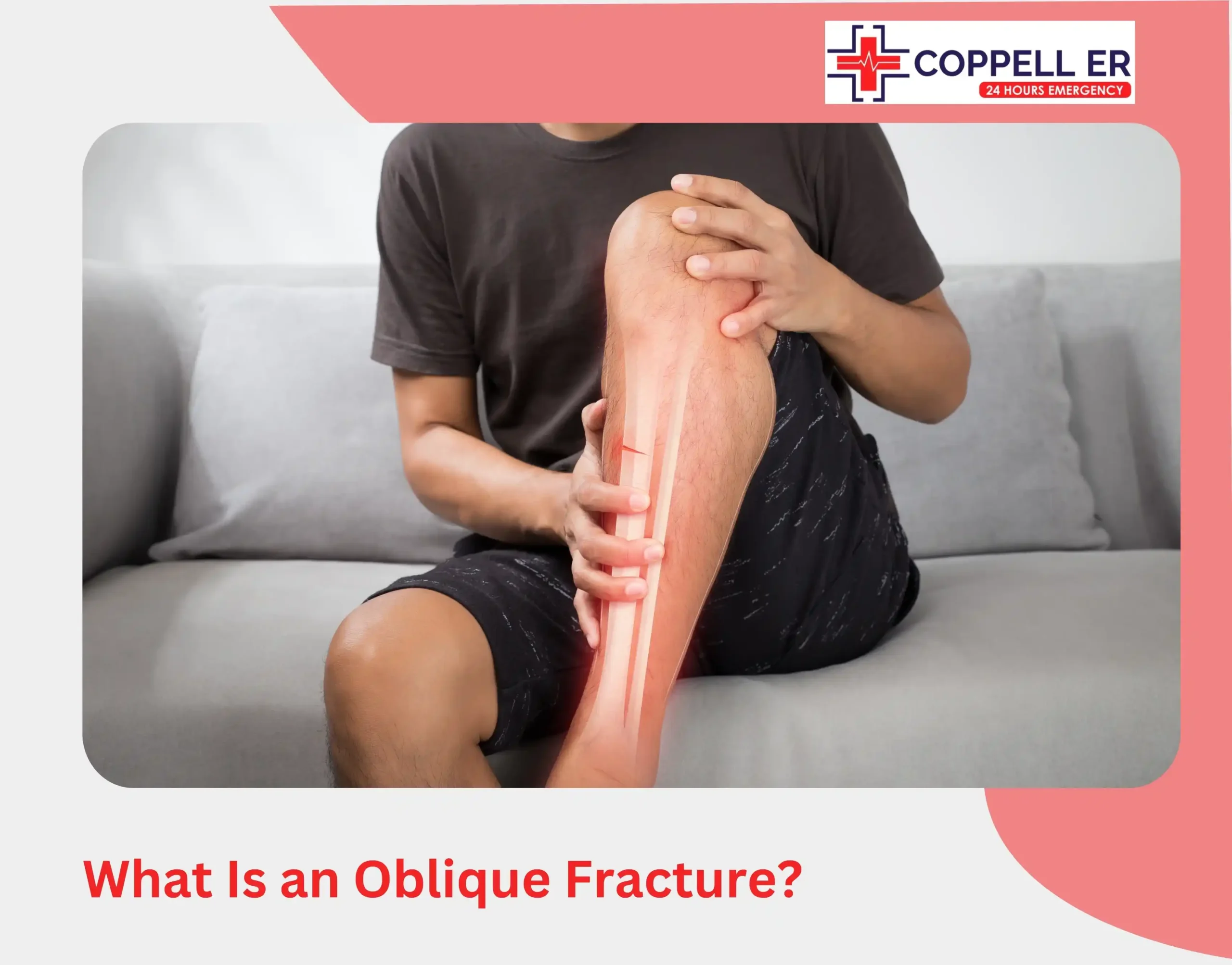 What Is an Oblique Fracture