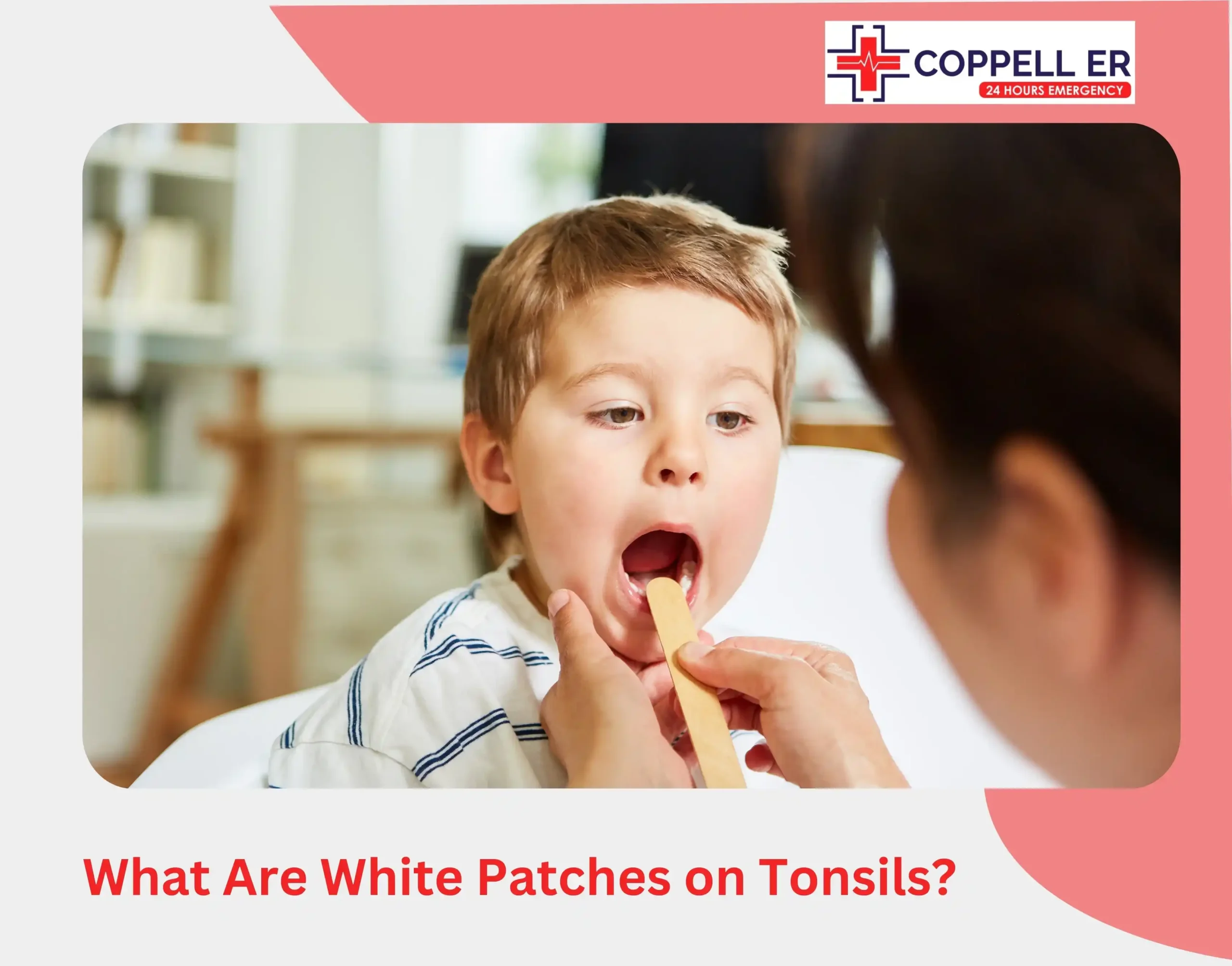 What Are White Patches on Tonsils