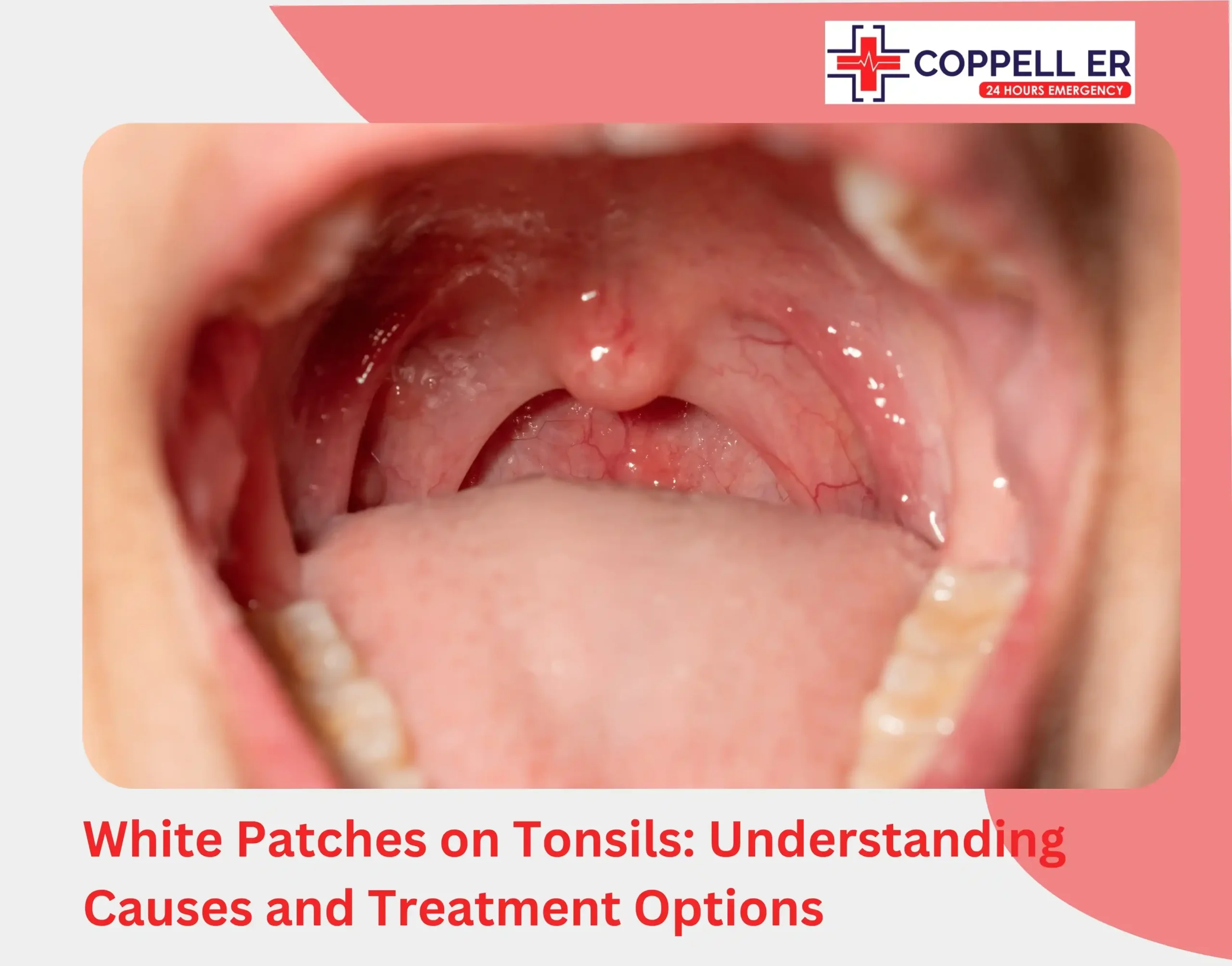 White Patches on Tonsils Understanding Causes and Treatment Options