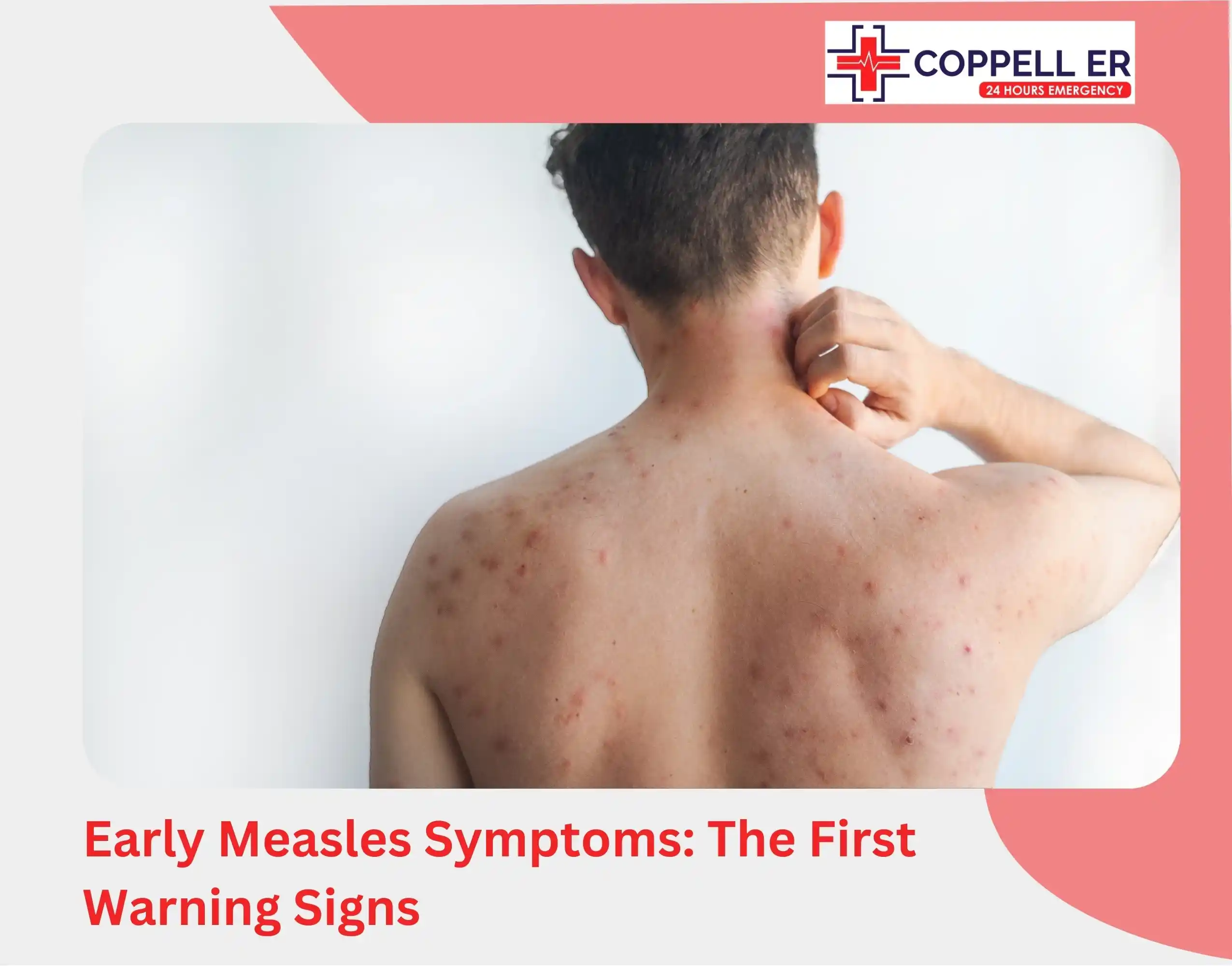 Early Measles Symptoms The First Warning Signs