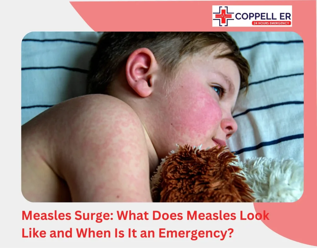 Measles Surge What Does Measles Look Like and When Is It an Emergency