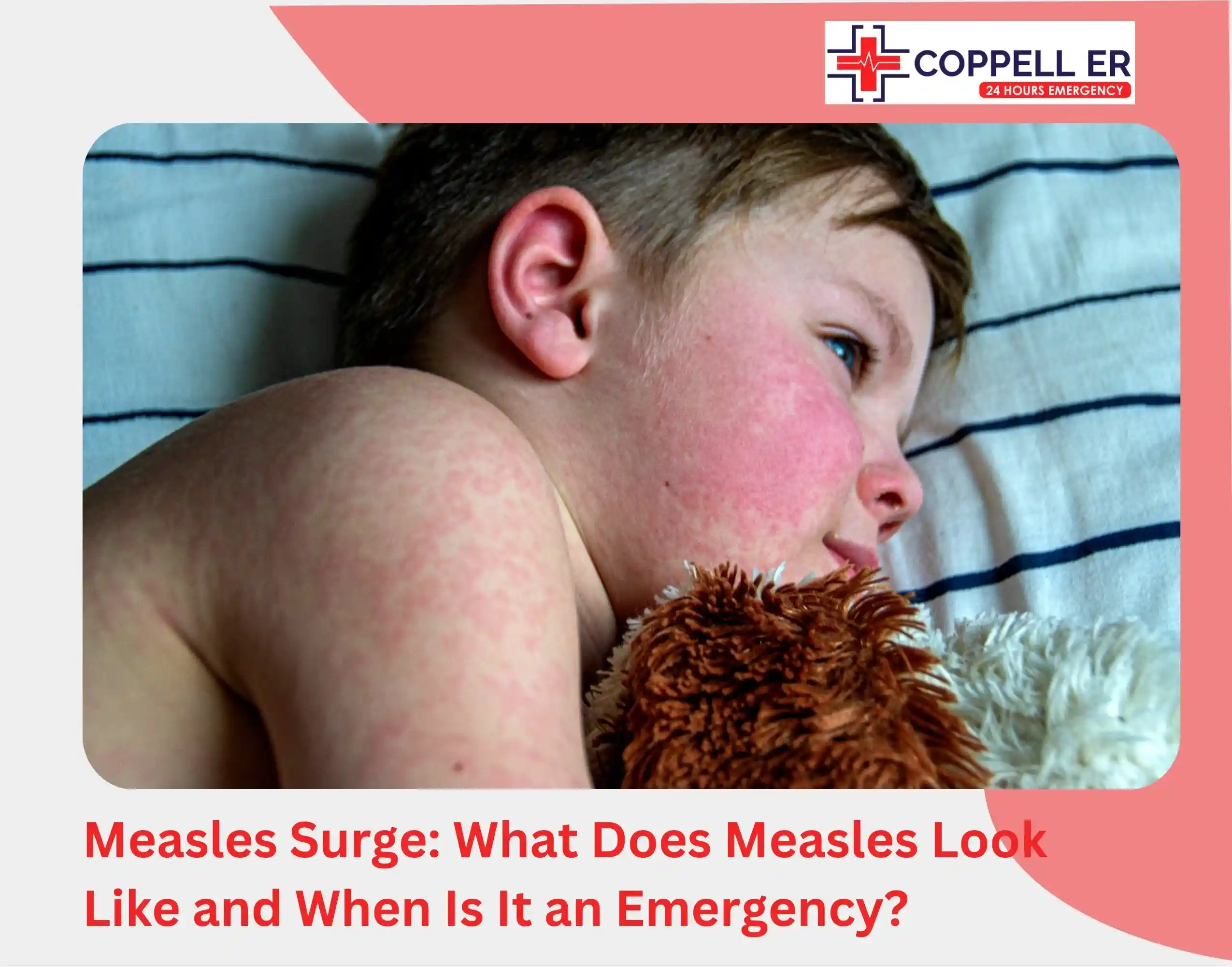 Measles Surge What Does Measles Look Like and When Is It an Emergency