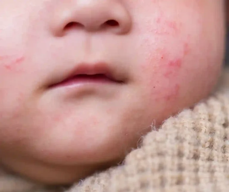 Children Rashes