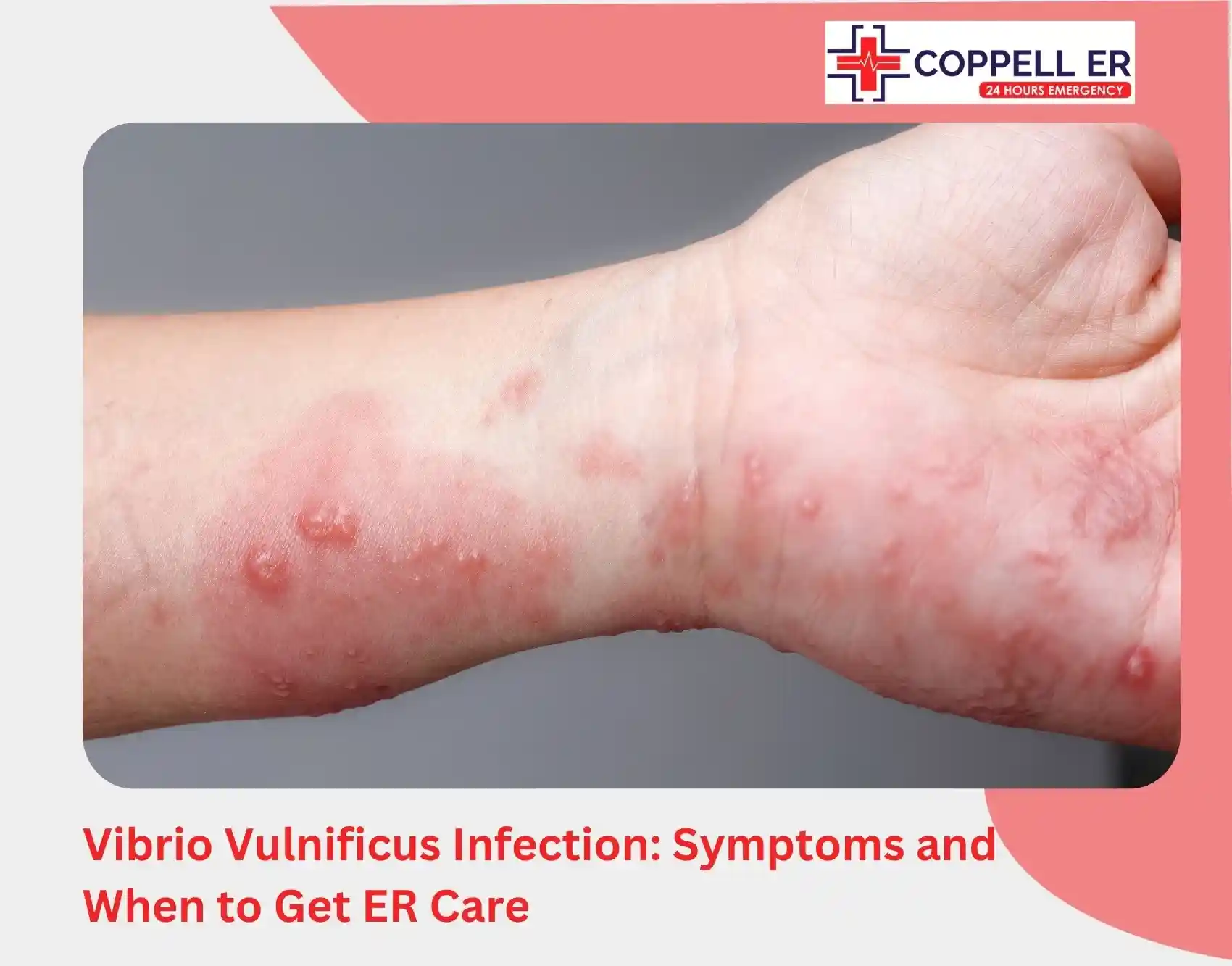 Vibrio Vulnificus Infection Symptoms and When to Get ER Care