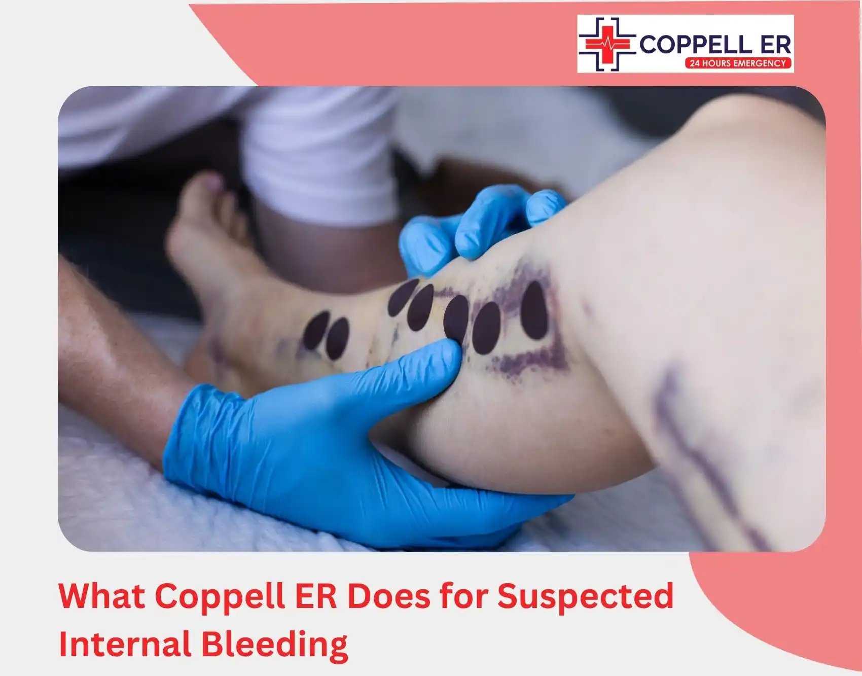 What Coppell ER Does for Suspected Internal Bleeding