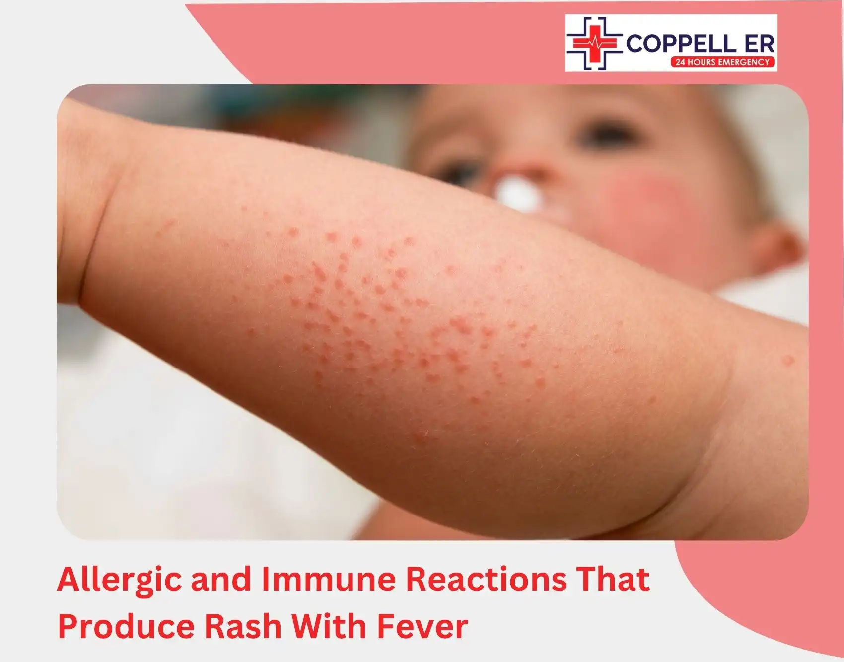 Allergic and Immune Reactions That Produce Rash With Fever